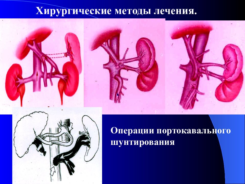 Портальная гипертензия хирургия презентация