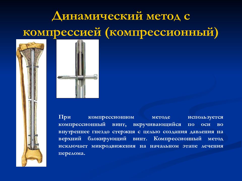 динамический винт остеосинтез. динамический винт. остеосинтез dhs фиксатором. остеосинтез dhs фиксатором. 001 импактор для dhs лезвия.