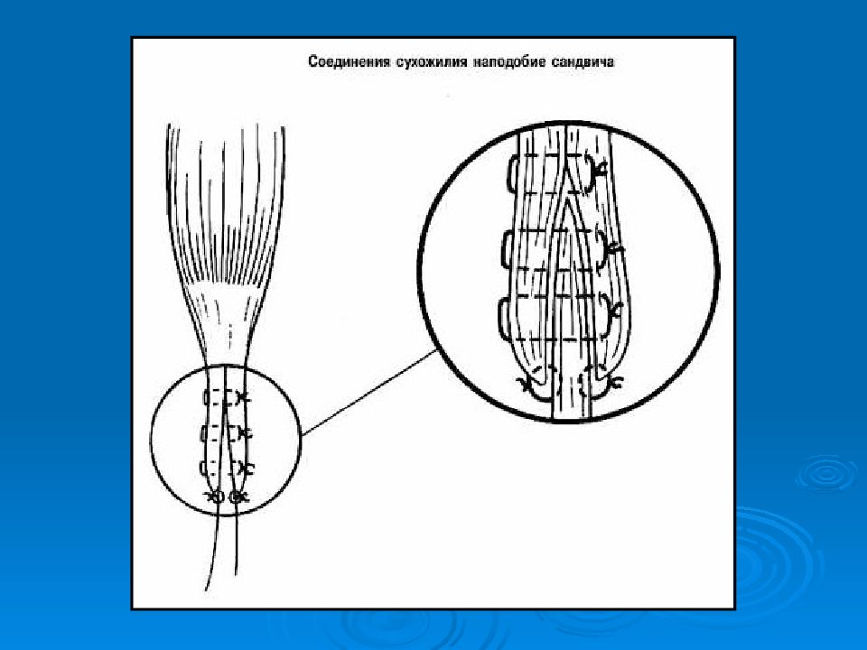 Презентация операции на сухожилиях