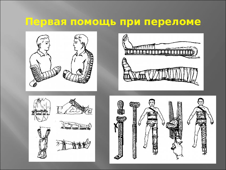 Перелом предплечья травматология презентация