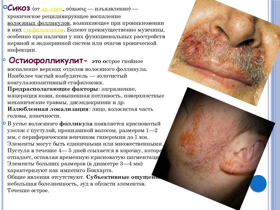 Тема: Пиодермия — презентация