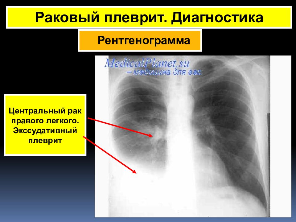 Плеврит легких. Экссудативный плеврит рентгенограмма. Экссудативный плеврит презентация. Плеврит описание рентгенограммы. Плеврит фото для презентации.