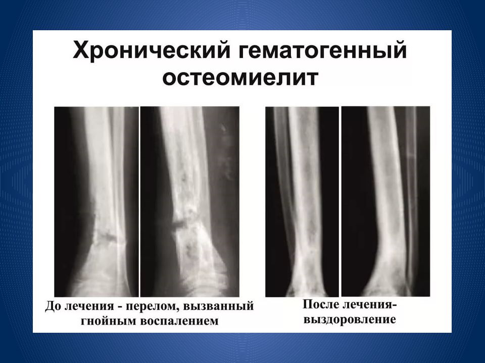 Патологический перелом конечности