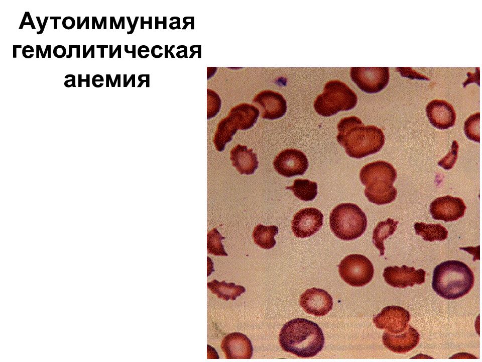 Гемолитическая анемия картинки