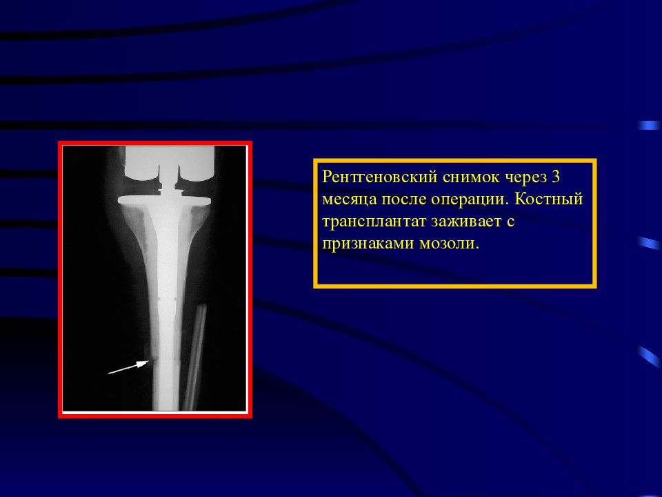 Опухоли костей презентация