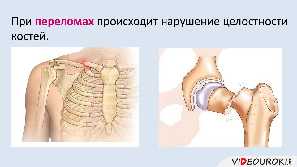 Вывих картинка для презентации