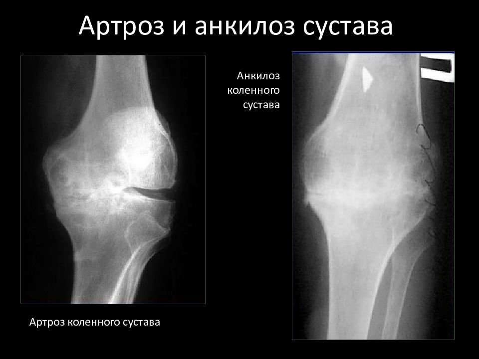 Анкилоз. Костный анкилоз в суставе. Анкилозирование сустава это. Фиброзно-костный анкилоз. Костный анкилоз коленного сустава.