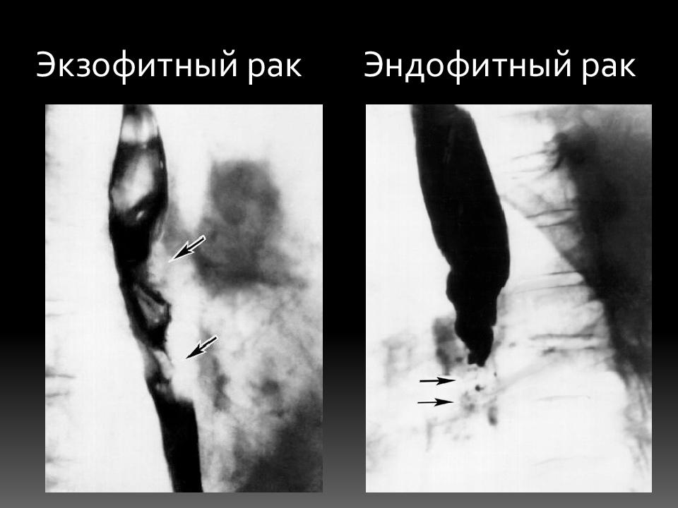 Рентгенологическая картина рака пищевода экзофитный эндофитный