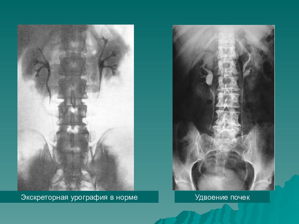 Урография почек. Нефрофаза экскреторная урография. Экскреторная урография и цистография. Урография мочевыводящих путей. Экскреторная урография гломерулонефрит.