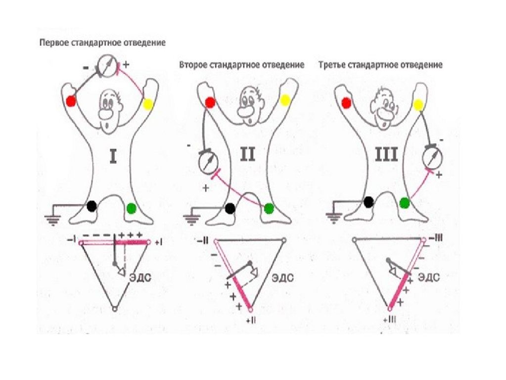 Отведения экг. Отведения ЭКГ схема. Стандартные отведения ЭКГ схема. Второе стандартное отведение ЭКГ. 3 Стандартное отведение ЭКГ электроды.
