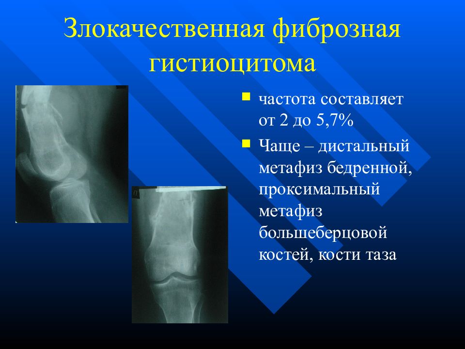 Злокачественные опухоли костей презентация