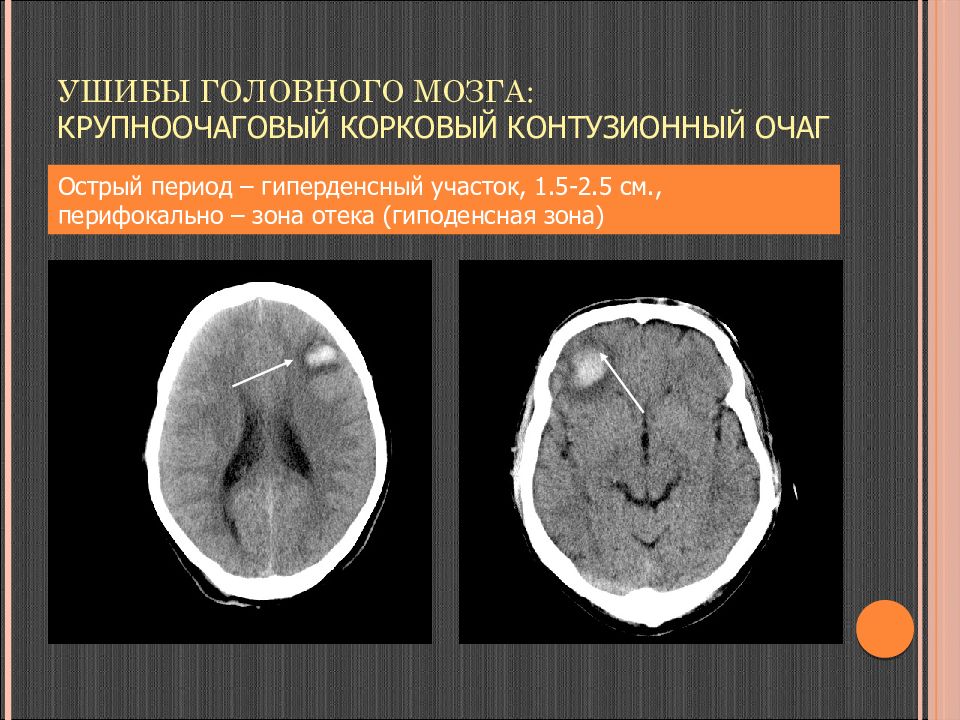 Что значит очаг в головном мозге. Гиперденсные очаги головного мозга на кт. Контузионный очаг в головном мозге на кт. Гиподенсная зона на кт головного мозга. Ушиб головного мозга 2 типа на кт.