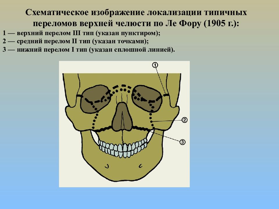 Перелом верхней челюсти. Перелом верхней челюсти по типу Ле фор 1. Лефор переломы верхней челюсти. Перелом верхней челюсти по Лефор 1.