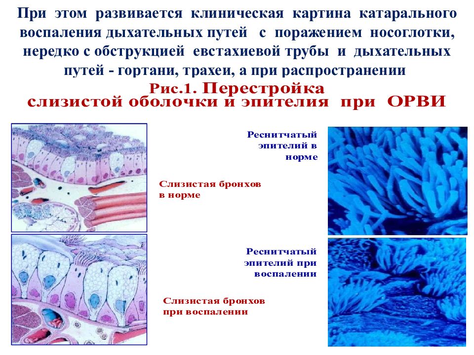 Катаральный грипп