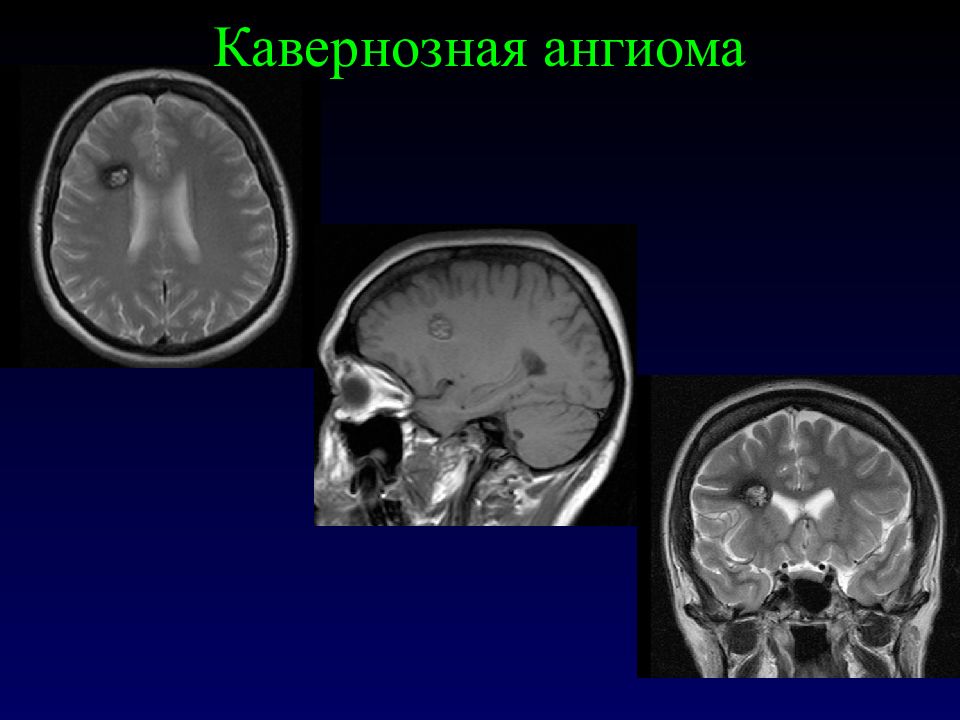 Ангиома правой лобной. Ангиома головного мозга кт. Кавернозная гемангиома головного мозга кт. Кавернозная ангиома головного мозга кт.