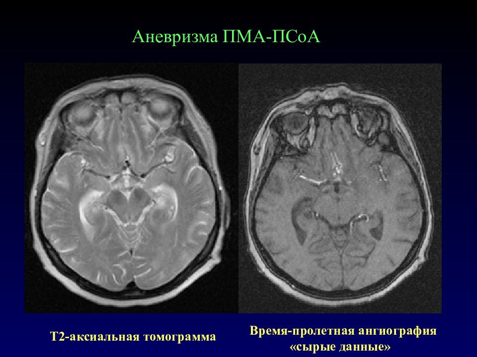 Сегмент а1 пма. Аневризма а2 сегмента левой ПМА. Мешотчатая аневризма ВСА мрт. Аневризма передней мозговой артерии.
