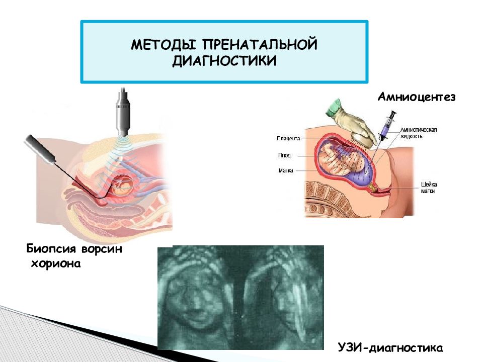 Пренатальная диагностика презентация