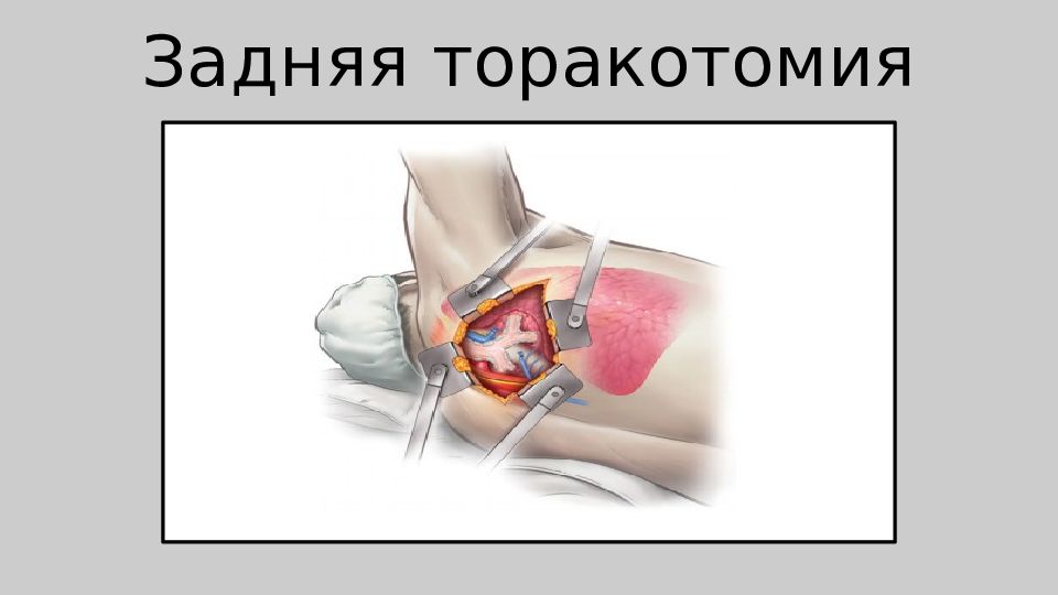 Торакальная хирургия презентация