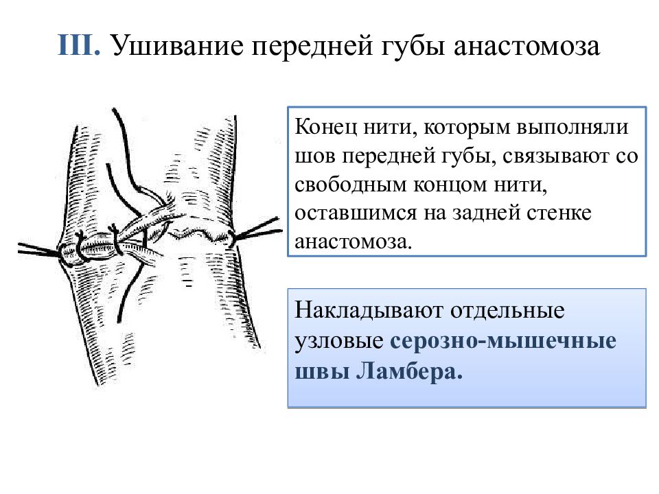 Кишечные анастомозы. Формирование анастомоза конец в конец. Швы при кишечном анастомозе. Формирование анастомоза.