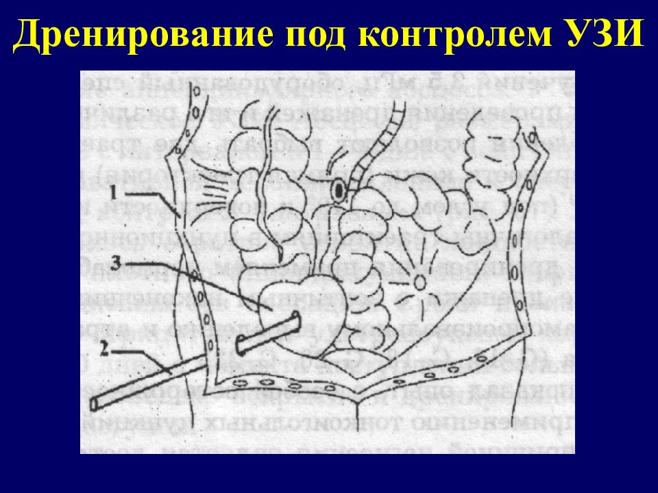 Острый аппендицит картинки для презентации