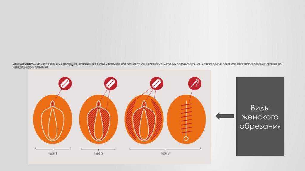 Виды обрезания. Обрезание у девочек схема что это такое. Обрезание у женщин схема. Как выглядит женское обрезание. Женское обрезание что это схема.