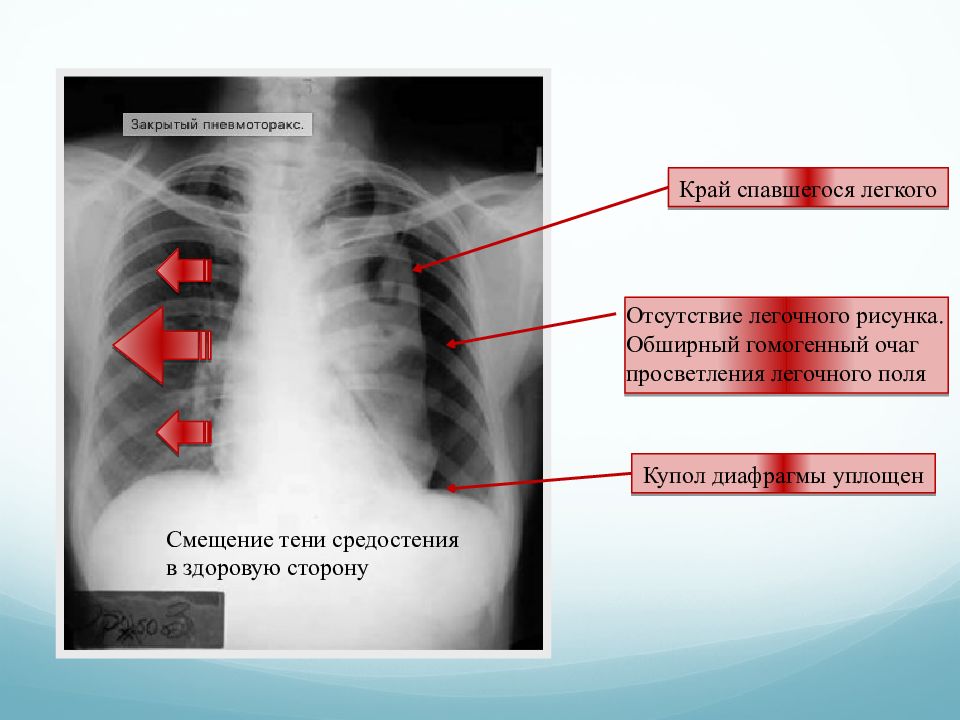 Травмы груди презентация