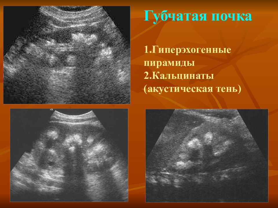 Паренхима почки гиперэхогенная. Гиперэхогенные пирамидки в почках на УЗИ. Синдром гиперэхогенных пирамид почек УЗИ. Синдром гиперэхогенных пирамидок почек на УЗИ. УЗИ синдром выделяющихся пирамидок в почках что это.