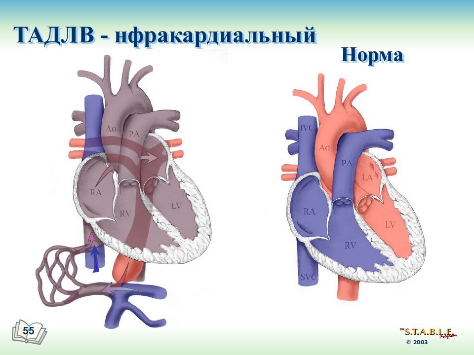 Двухкамерное сердце. Тотальный аномальный дренаж легочных вен. Полный аномальный дренаж легочных вен. Тотальный аномальный дренаж легочных вен у новорожденных.