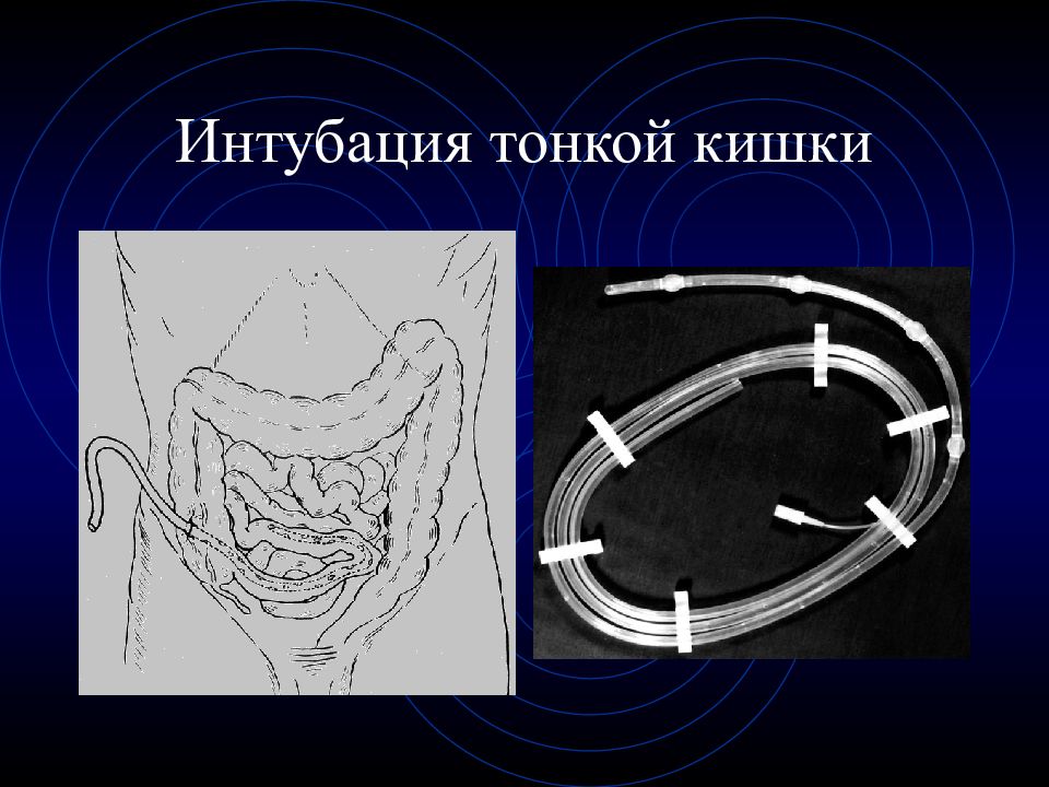 Зонд в кишечник