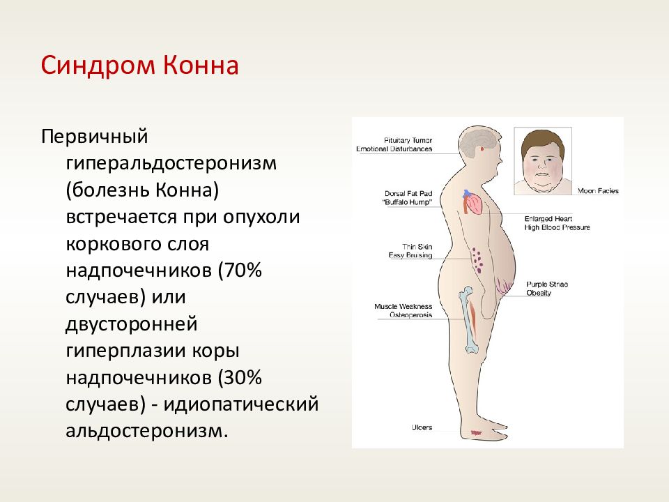 Первичный гиперальдостеронизм презентация