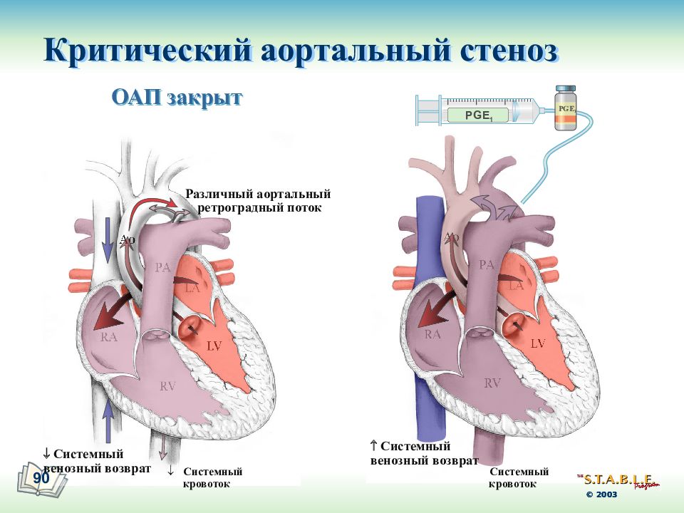 Аортальный стеноз. Критический стеноз аорты. Закрытие открытого артериального протока. Стеноз артериального протока. Критический стеноз аортального клапана операция бесплатно.