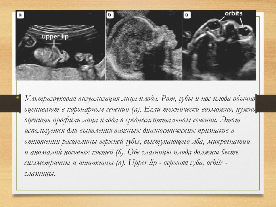 Диабетическая фетопатия презентация