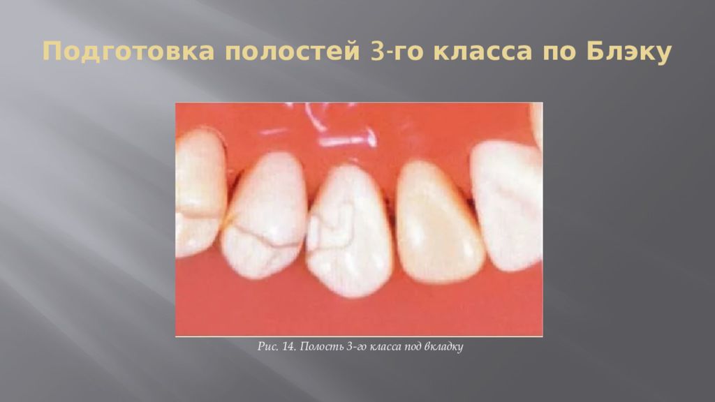 Классы полостей. Препарирование по 3 классу Блэка. 3 Класс Блэка препарирование. Полость 3 класса по Блэку. Третий класс по Блэку препарирование.