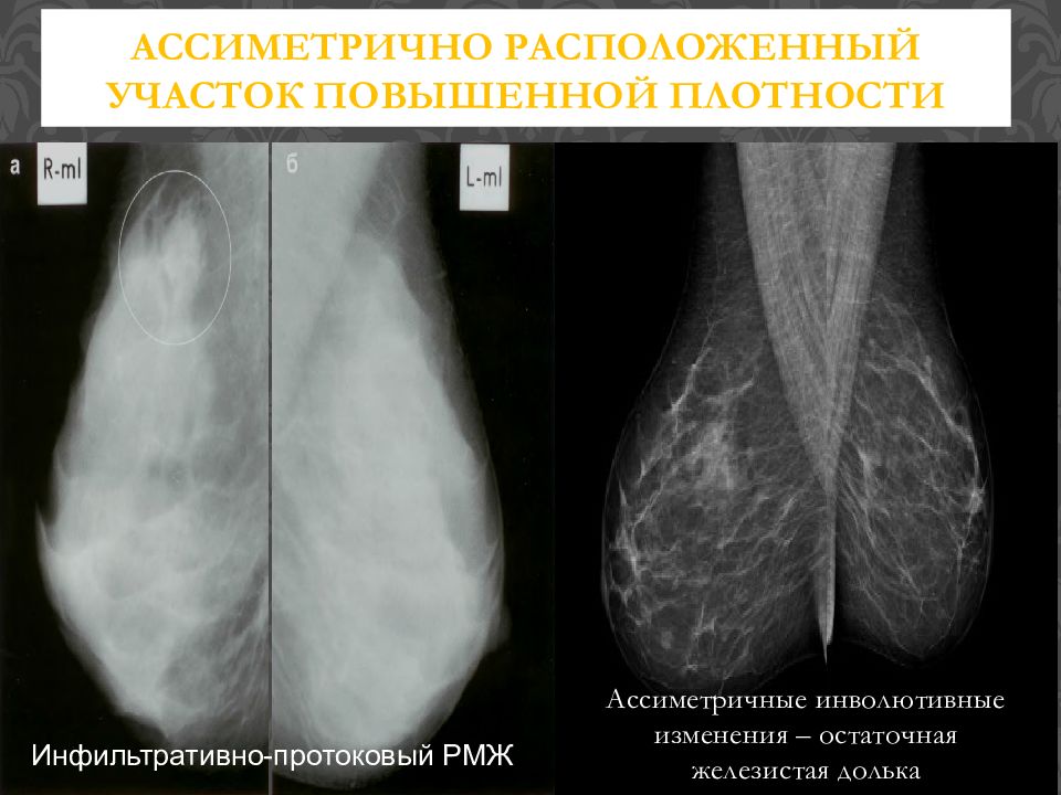 Картина инволютивных изменений молочных желез