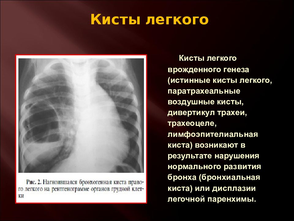 Киста легкого. Врожденная киста легкого. Врожденные заболевания легких. Пороки развития органов грудной клетки. Врожденная патология легких.