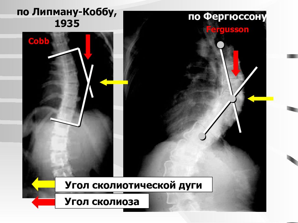 Угол кобба. Сколиоз позвоночника рентген степени. Рентген сколиоз угол Кобба. Угол сколиоза по чаклину рентген. Измерение угла сколиоза по чаклину.