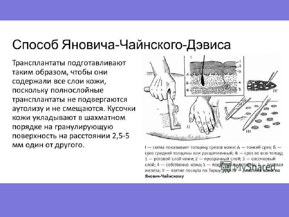 Свободная пересадка кожи презентация