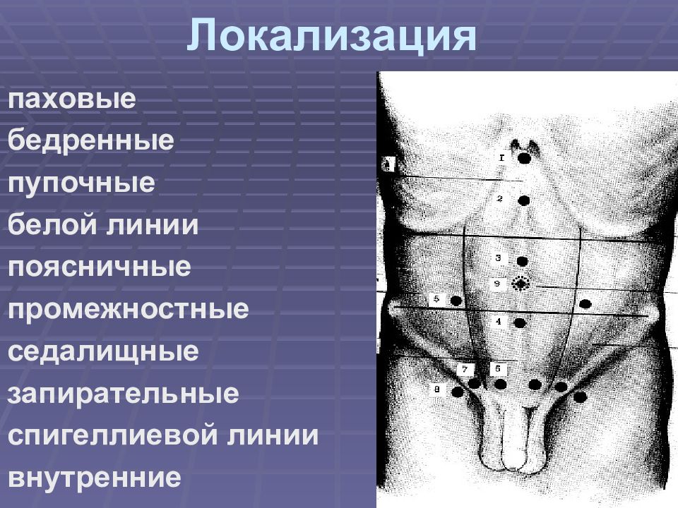 Презентация грыжа живота