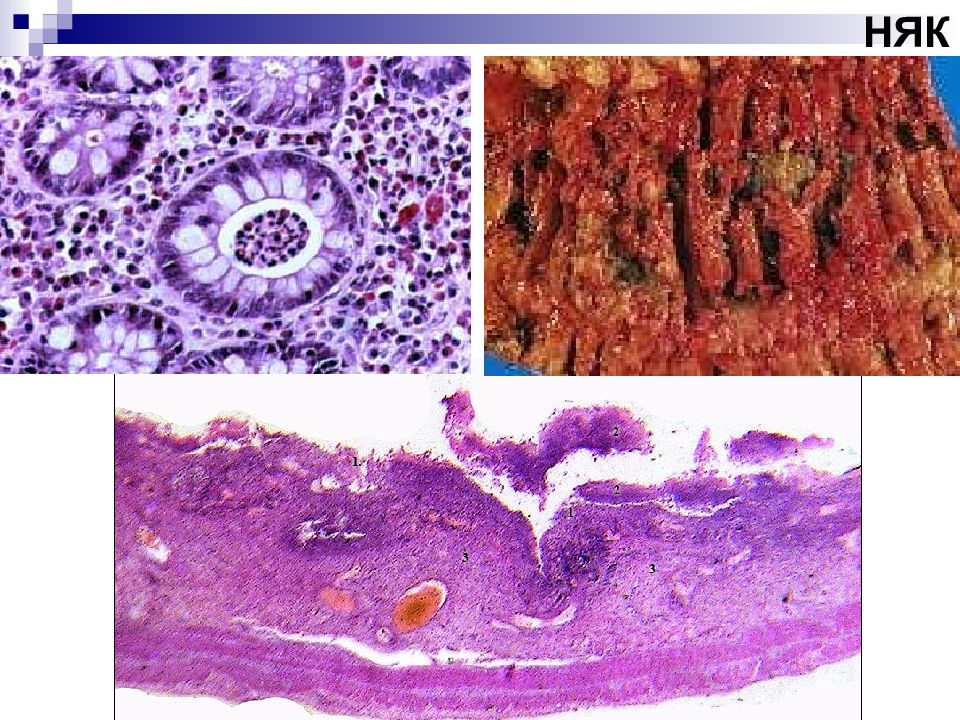 Неспецифический язвенный колит. Псевдомембранозный колит гистология. Псевдомембранозный колит макропрепарат. Псевдомембранозный колит эндоскопия. Неспецифический язвенный колит макропрепарат.