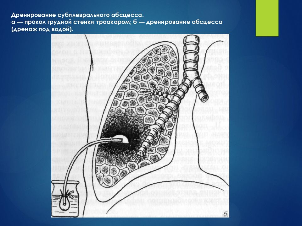 Дренирование. Дренирование абсцесса по Мональди. Трансторакальное дренирование полости абсцесса. Дренирование постинъекционного абсцесса. Чрескожное дренирование абсцесса.