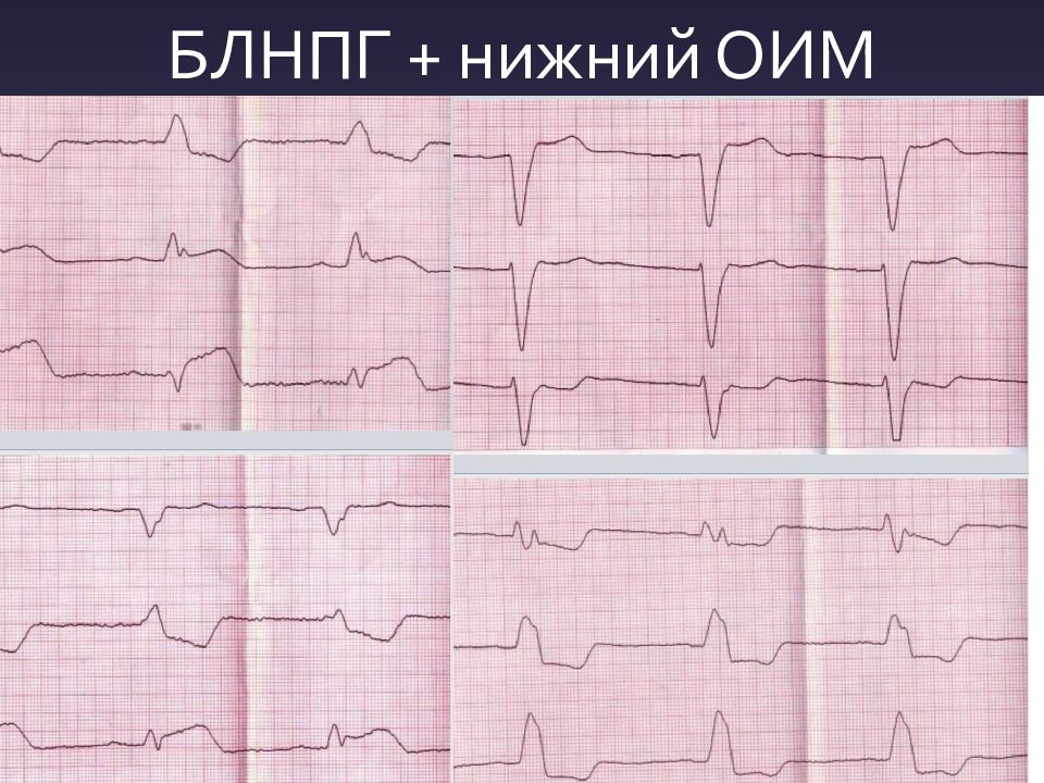 Элевация st на экг