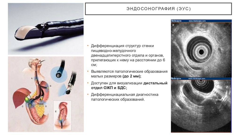 Эус желудка. Эндосонография желудка. Эндоскопическая ультрасонография. Эндоскопический ультразвук. Эндосонография стойка.