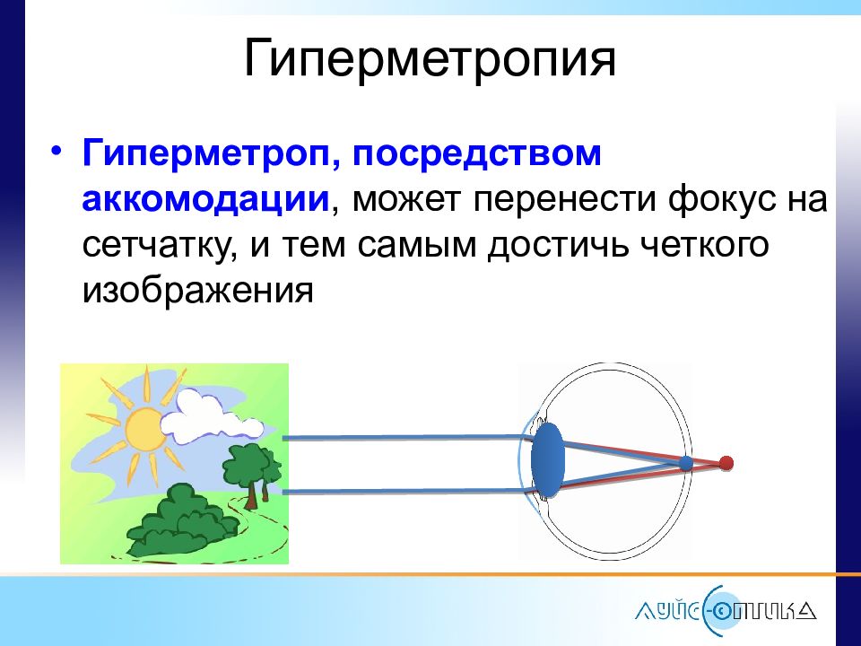 Гиперметропия. Гиперметроп. Гиперметропия классификация. Гиперметропия фокус. Аккомодация гиперметропия.