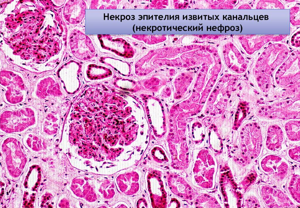 Нефроз. Некротический нефроз гистология. Нефротический нефроз патанатомия. Некротический нефроз патологическая анатомия. Некротический нефроз ( некроз эпителия канальцев почек..