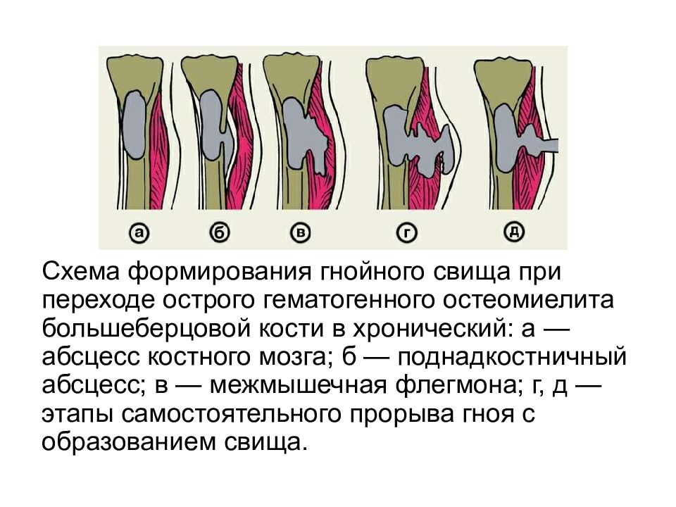 Сформированные свищи. Острый гематогенный остеомиелит большеберцовой кости. Гематогенный остеомиелит схема. Хронический остеомиелит большеберцовой кости кт. Хронический остеомиелит бедренной кости кт.