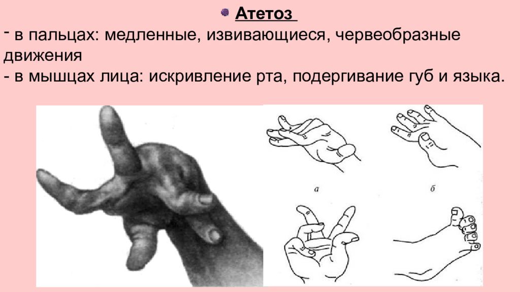 Пропедевтика нервных болезней презентация