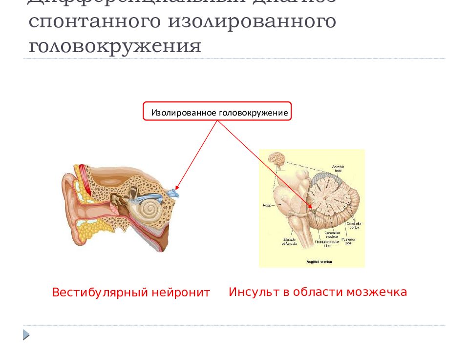 Вестибулярный нейронит. Вестибулярный нейронит дифференциальная диагностика. Вестибулярный нейронит герпетический. Правосторонний вестибулярный нейронит. Нистагм при вестибулярном нейроните.