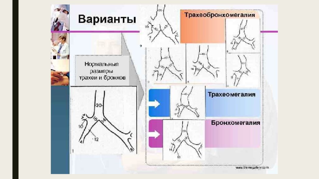 Пороки Развития Трахеи