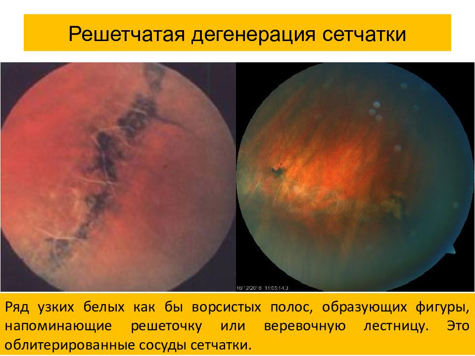 Презентация на тему отслойка сетчатки
